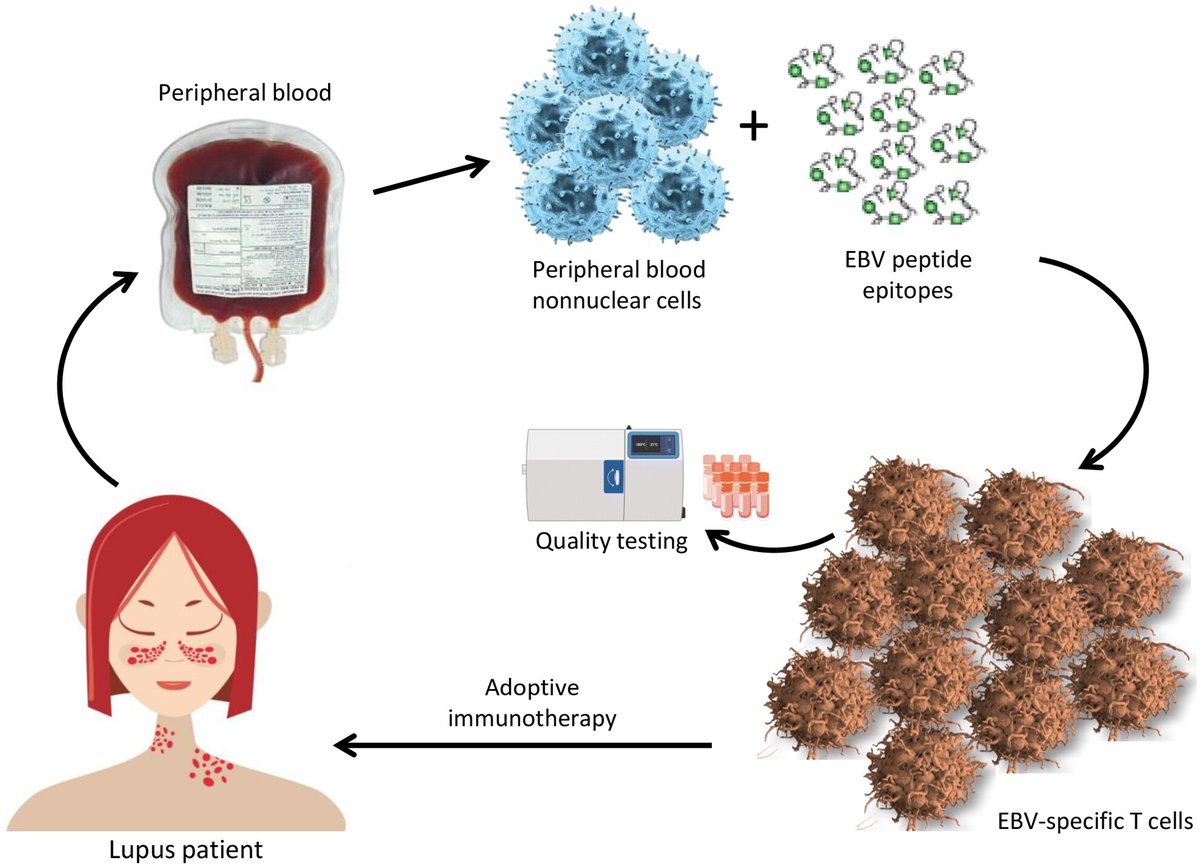 Rajiv Khanna (@khanna_rajiv) on Twitter photo Autologous Epstein–Barr virus‐specific adoptive T‐cell therapy in a patient with lupus nephritis <a href="/ClinTransImmuno/">Clinical & Translational Immunology</a> onlinelibrary.wiley.com/doi/full/10.10… <a href="/QIMRB_Institute/">QIMR Berghofer</a> <a href="/qldhealth/">Queensland Health</a> <a href="/QLDimmunology/">Queensland Immunology Research Centre</a> <a href="/LupusResearch/">Lupus Research</a> <a href="/LupusOrg/">Lupus Foundation of America</a> <a href="/celltherapynews/">Cell Therapy News</a> <a href="/HealthTQld/">Health Translation Queensland</a> <a href="/LSQld/">Life Sciences Queensland Ltd (LSQ)</a> Autologous Epstein–Barr virus‐specific adoptive T‐cell therapy in a patient with lupus nephritis <a href="/ClinTransImmuno/">Clinical & Translational Immunology</a> onlinelibrary.wiley.com/doi/full/10.10… <a href="/QIMRB_Institute/">QIMR Berghofer</a> <a href="/qldhealth/">Queensland Health</a> <a href="/QLDimmunology/">Queensland Immunology Research Centre</a> <a href="/LupusResearch/">Lupus Research</a> <a href="/LupusOrg/">Lupus Foundation of America</a> <a href="/celltherapynews/">Cell Therapy News</a> <a href="/HealthTQld/">Health Translation Queensland</a> <a href="/LSQld/">Life Sciences Queensland Ltd (LSQ)</a>