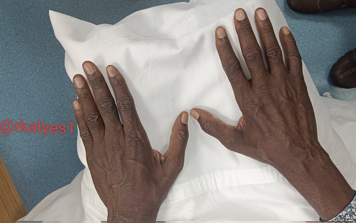 🏥 As a specialist. It is easy to get lost in our field of specialization to the detriment of our patients!
👇 76yr/M with CKD comes in with repeated loss of memory 
 👉 His son reports that he signed off family property to some men!
🔥 What do you see?
🔥 What is the diagnosis?