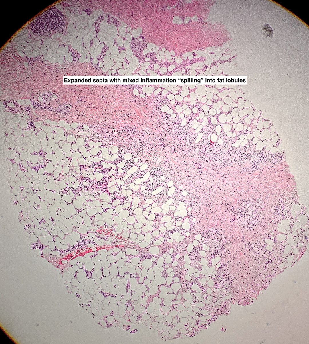 Path4People's tweet photo. I occur usually on the shins as red, tender nodules
I am associated w infection, medications, and systemic diseases
I am considered the classic septal panniculitis and usually resolve spontaneously
Who am I?
#pathx #pathtwitter #dermpath #path4people #pathagonia #medx https://t.co/GMJoQtrwAv