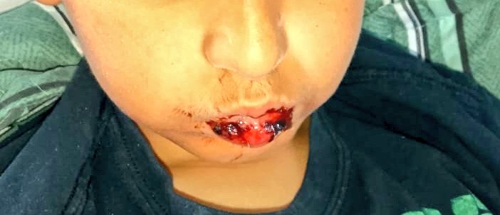 anny_mella's tweet photo. @meganoticiascl Mi sobrino lleva más de 10 días le salieron ampollas en su boca y aún sigue con sondas , así empezó https://t.co/zKOnlU4EEU