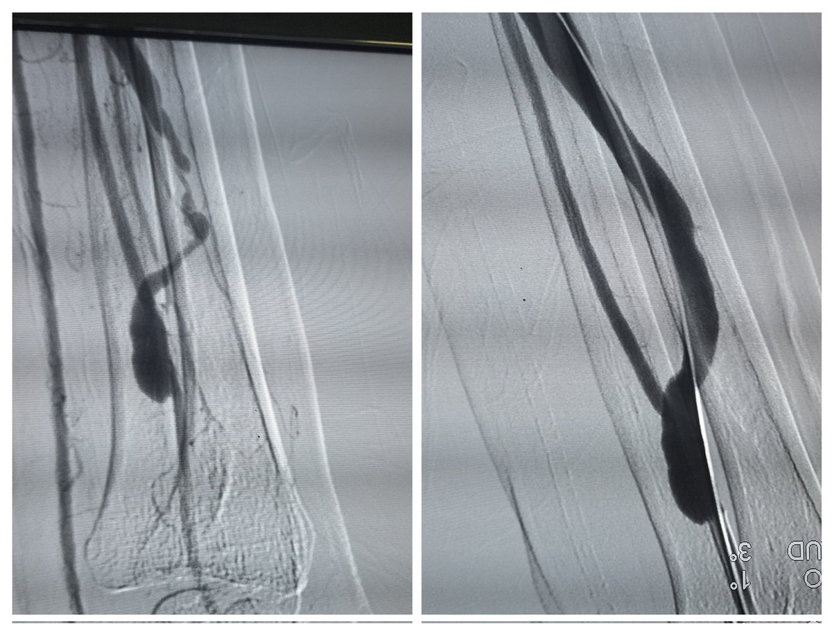 vascularsrgn's tweet image. Friday used to be access day during training  @sctimst_tvm , @PShivanesandr  guiding  us through AVF&apos;s daylong. Todays case  @tenderpalm_lko, Patient diagnosed JXA stenosis n came from  far to get his AVF serviced as he was feeling a pulse . @VarenyamVasc #accessed @theveincon