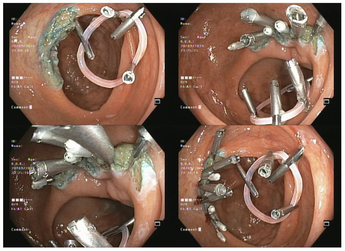 drbiswaPATRA's tweet photo. Ileocecal valve obstructive lipoma. Household rubber band was used for traction. 
Faced difficulty in cutting the rubber band and had to open up the clip holding the lesion to detach it.. What’s ur go to internal traction method of choice in absence of dedicated devices ?? https://t.co/cPiVjQKr5N