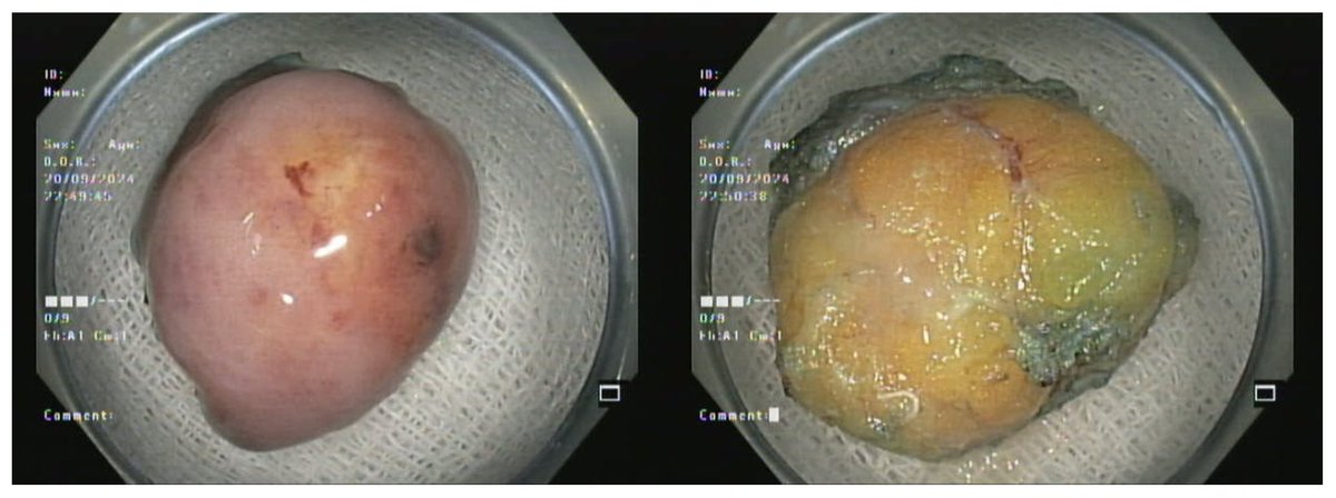 drbiswaPATRA's tweet photo. Ileocecal valve obstructive lipoma. Household rubber band was used for traction. 
Faced difficulty in cutting the rubber band and had to open up the clip holding the lesion to detach it.. What’s ur go to internal traction method of choice in absence of dedicated devices ?? https://t.co/cPiVjQKr5N