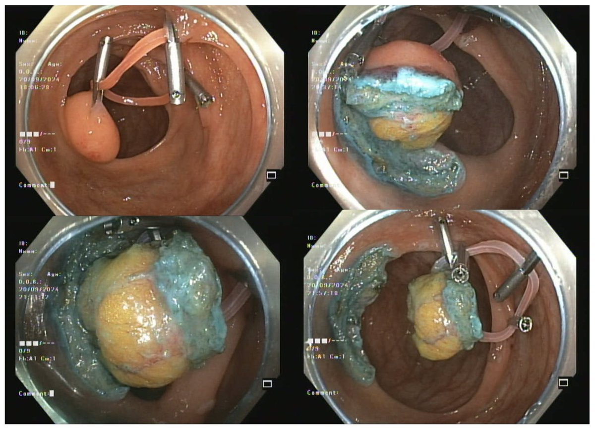 drbiswaPATRA's tweet photo. Ileocecal valve obstructive lipoma. Household rubber band was used for traction. 
Faced difficulty in cutting the rubber band and had to open up the clip holding the lesion to detach it.. What’s ur go to internal traction method of choice in absence of dedicated devices ?? https://t.co/cPiVjQKr5N