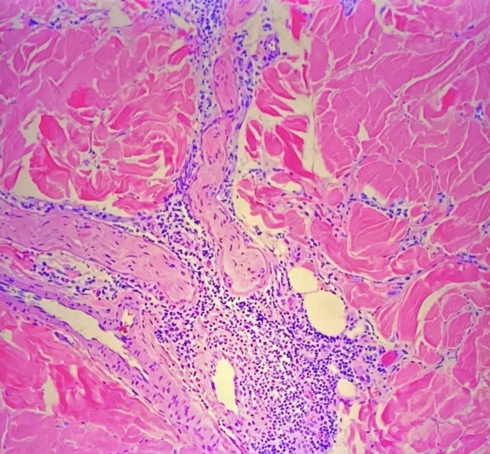 Maxwell Fung, MD (@fungmaxwell) on Twitter photo Perineural lymphoplasmacytic infiltrates in morphea. Dr. Agrawal #ASDP24 #dermpath <a href="/ASDPTweets/">American Society of Dermatopathology</a> Perineural lymphoplasmacytic infiltrates in morphea. Dr. Agrawal #ASDP24 #dermpath <a href="/ASDPTweets/">American Society of Dermatopathology</a>