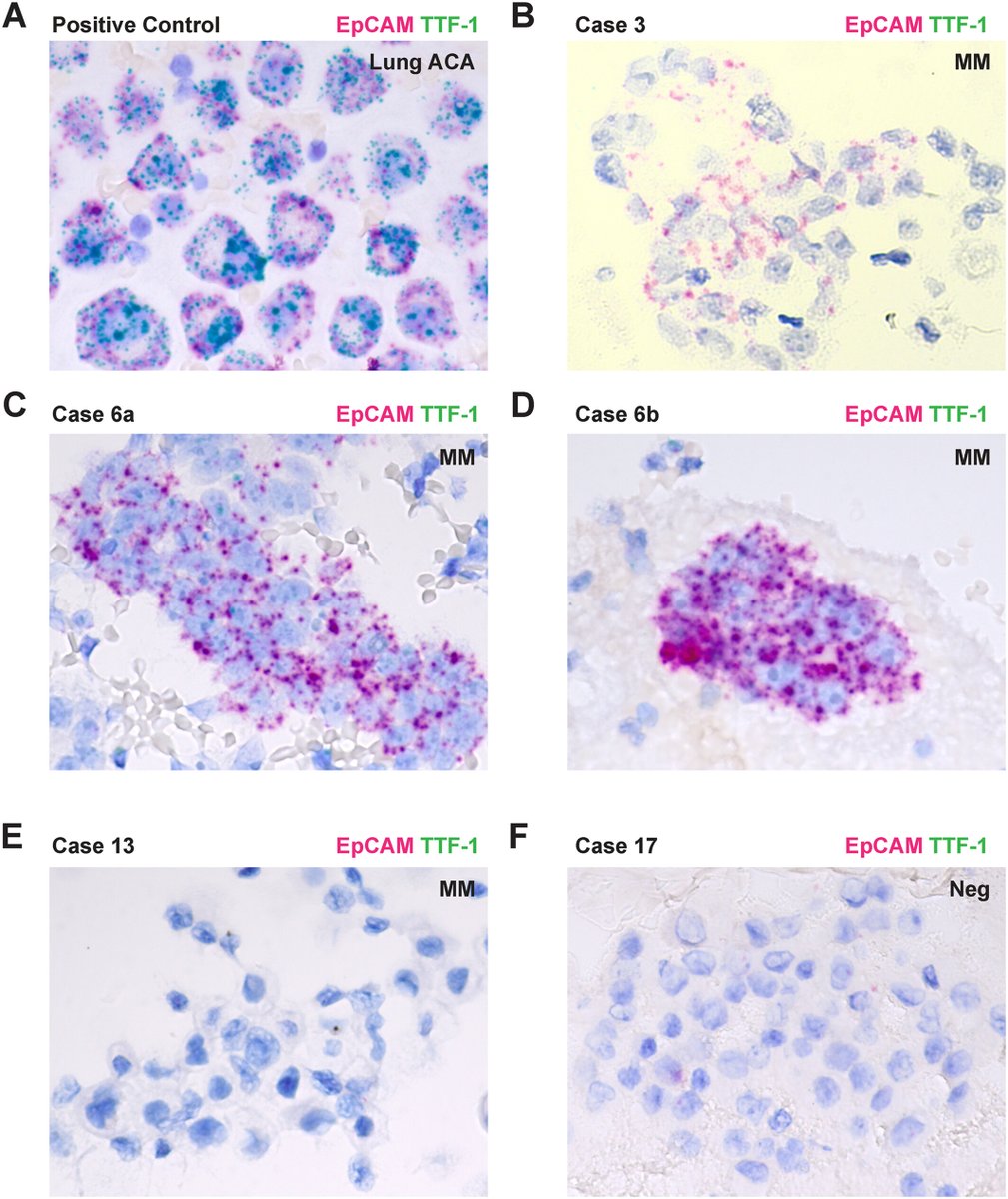 Cancer Cytopathology (@cancercytopath) on Twitter photo Don't skip the final Short Course of #ASCyto24 today at 10:00am! "Mentorship with Purpose: An Interactive Workshop to Accelerate Your Career, Empower Others, Ignite Connections" from EB member <a href="/Alaricelowe/">Ali Lowe</a>
Read a bit of Dr. Lowe's spectacular work here: acsjournals.onlinelibrary.wiley.com/doi/10.1002/cn⌠Don't skip the final Short Course of #ASCyto24 today at 10:00am! "Mentorship with Purpose: An Interactive Workshop to Accelerate Your Career, Empower Others, Ignite Connections" from EB member <a href="/Alaricelowe/">Ali Lowe</a>
Read a bit of Dr. Lowe's spectacular work here: acsjournals.onlinelibrary.wiley.com/doi/10.1002/cnâŚ