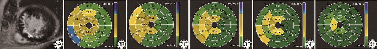 CJMRI_2010's tweet photo. The signal threshold versus reference mean (#STRM) selection for deep learning reconstruction (#DLR)-based late gadolinium enhancement (#LGEDL)  #MRI helps improve clinical decision-making in patients with unrecognized myocardial infarction (#UMI).
https://t.co/pc5yeNbTQA https://t.co/7UyqnQA400