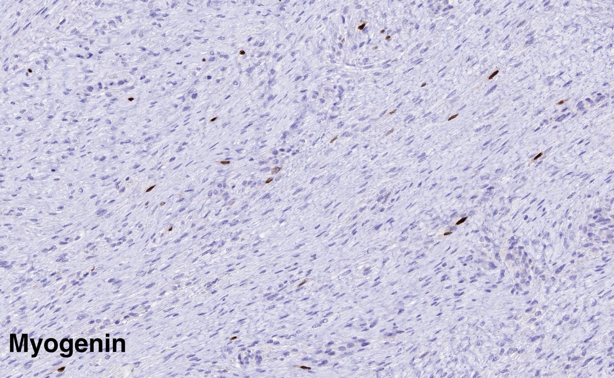 Focal myogenin in desmoid-type fibromatosis, potential pitfall
#BSTpath #myogenin #desmoid #fibromatosis #spindlecellRMS