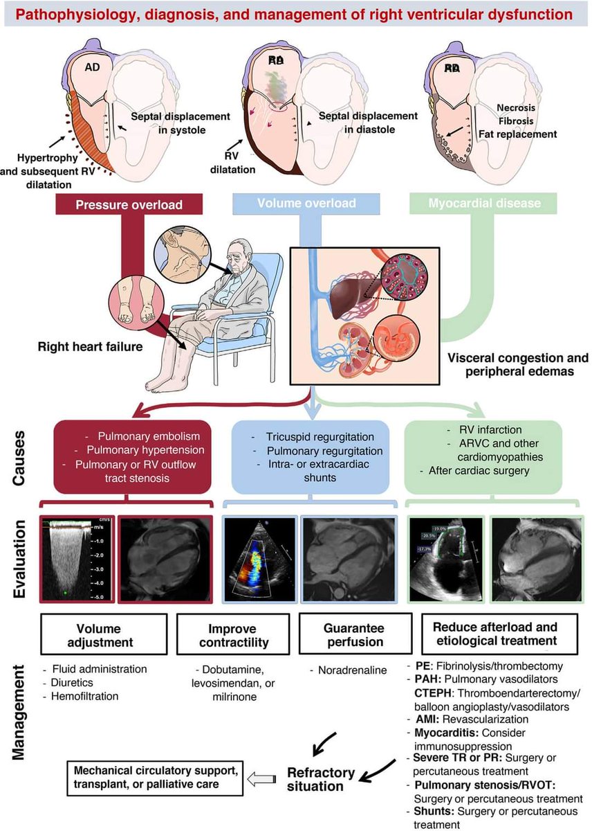 🔴Right ventricular dysfunction: Evaluation, and Treatment⤵️ #2024Review #OpenAccess 

🔹revespcardiol.org/en-right-ventr…
#Cardiology #CardioTwitter #medical #meded #medtwitter #cardiotwiteros #CardioEd #paramedic