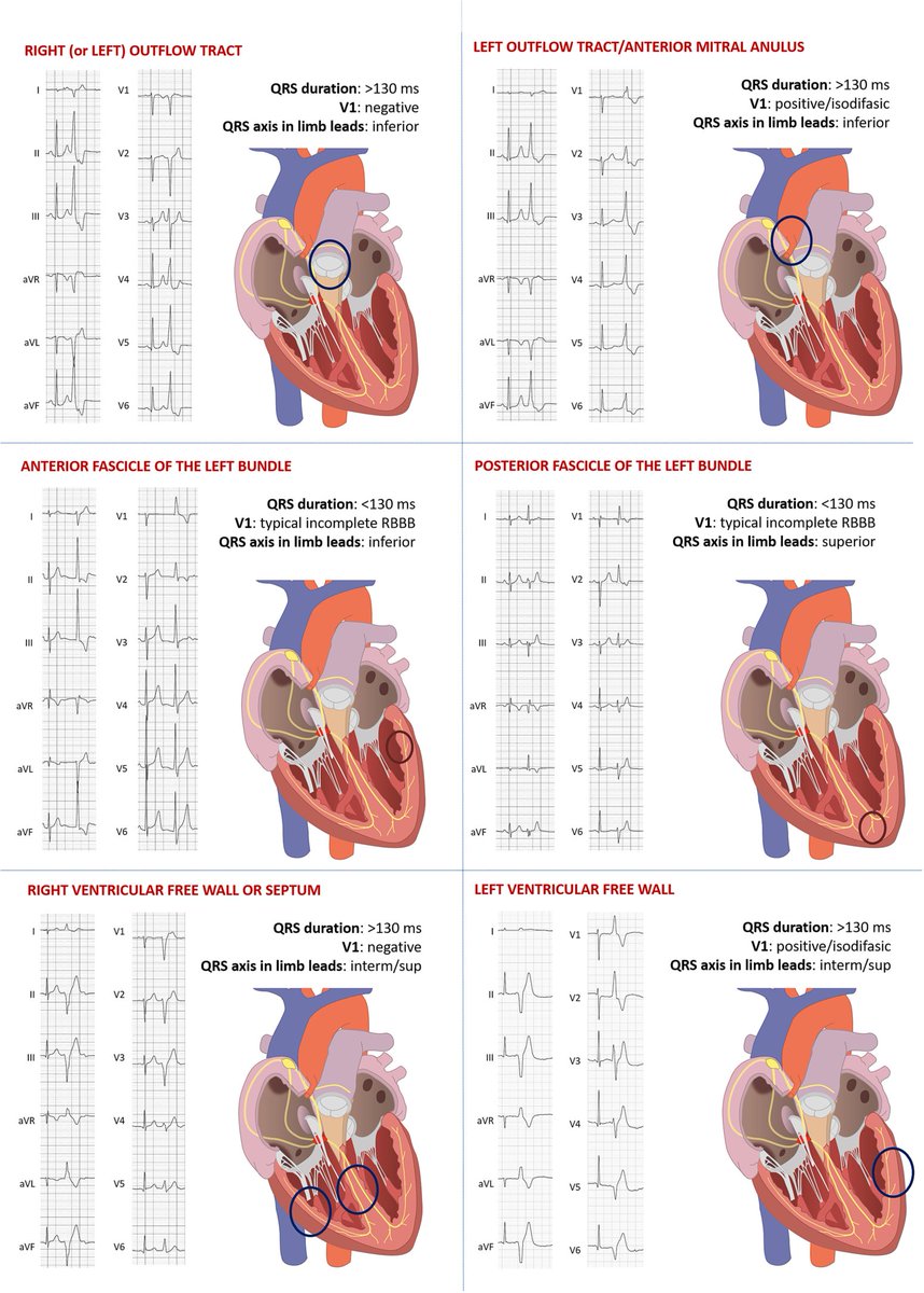 🔴Interpretation and management of premature ventricular beats in athletes:⤵️ #OpenAccess 

🔹internationaljournalofcardiology.com/article/S0167-… 
 #Cardiology #FOAMed #MedEd #medstudent #paramedic #Cardiology #CardioEd #medtwitter #meded #CardioTwitter #cardiotwiteros  #MedX