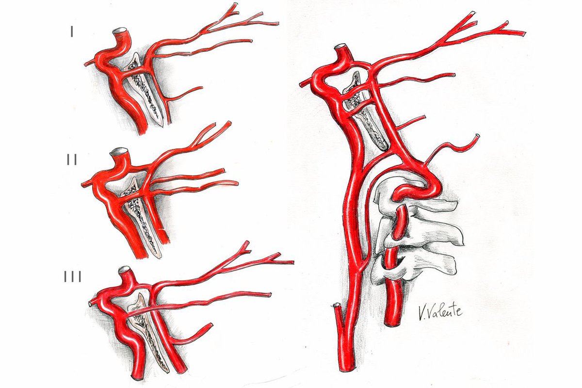 Braydon Dymm, MD (@braydondymm) on Twitter photo Persistent Trigeminal Artery (<1% prevalence) – A rare embryonic remnant that connects the ICA with the basilar artery
It may serve as a collateral pathway but can be associated with a variety of vascular lesions Persistent Trigeminal Artery (<1% prevalence) – A rare embryonic remnant that connects the ICA with the basilar artery
It may serve as a collateral pathway but can be associated with a variety of vascular lesions