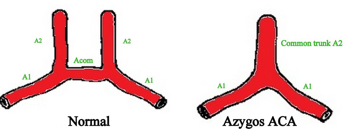 Braydon Dymm, MD (@braydondymm) on Twitter photo Azygos Anterior Cerebral Artery (~0.3-2% prevalence) – A single vessel replaces the paired ACAs, centralizing blood supply
This makes it vulnerable to complete anterior territory infarction, possibly presenting as sudden bilateral lower extremity weakness Azygos Anterior Cerebral Artery (~0.3-2% prevalence) – A single vessel replaces the paired ACAs, centralizing blood supply
This makes it vulnerable to complete anterior territory infarction, possibly presenting as sudden bilateral lower extremity weakness