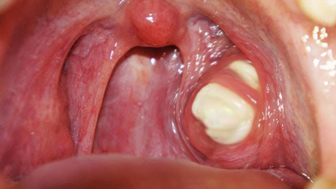 zizelle_'s tweet photo. TONSIL STONES: WHAT YOU NEED TO KNOW

Have you been dealing with bad taste or mouth odor that has refused to go away?

You might have accumulated dirt and bacteria lodged in your throat.

How do they get there?
How can the situation be managed? https://t.co/lyNuYSvLpk