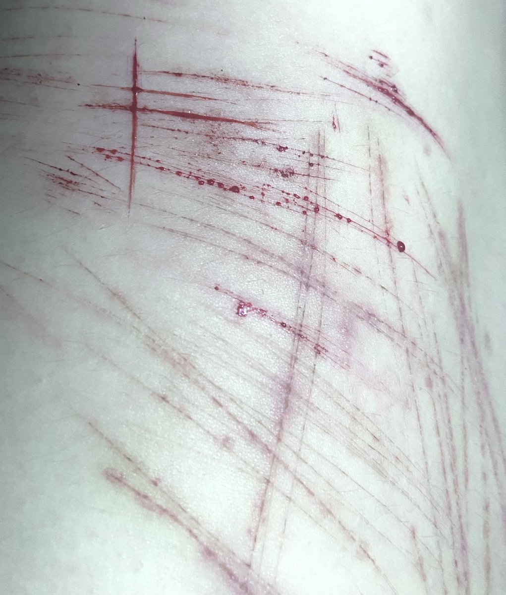 pearl_myname's tweet photo. not the urge to cut, the urge to see the new scars and blood 
.
.
.
.
.
.
.
#shtwt https://t.co/zDxby4OXsp