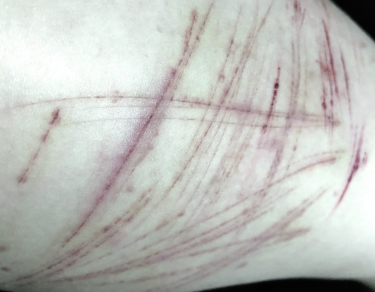 pearl_myname's tweet photo. not the urge to cut, the urge to see the new scars and blood 
.
.
.
.
.
.
.
#shtwt https://t.co/zDxby4OXsp