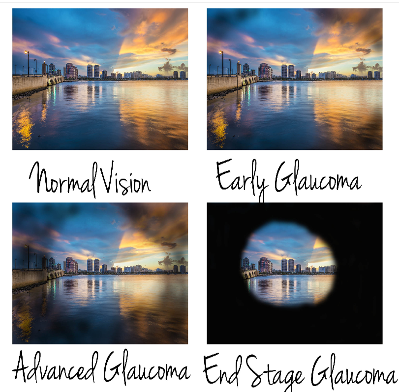 saludvysual's tweet photo. Prevenir el #glaucoma.
No esperes a que sea demasiado tarde.
👁
#descanso #alimentacion #verduras #sal #azucar
#controlvisual #presionocular #ceguera
Un consejo de #tuopticadeconfianza
& #AEOptometristas #zasvision #MetroColon https://t.co/zjSh0oHBKs