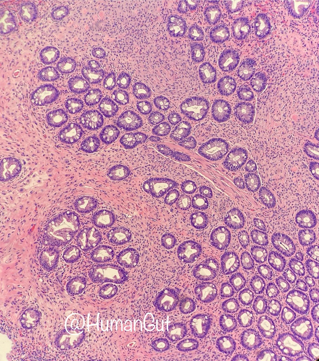 HumanGut's tweet photo. 57-year-old male sigmoid colon polyp. What is it? https://t.co/cdY8cInNE5