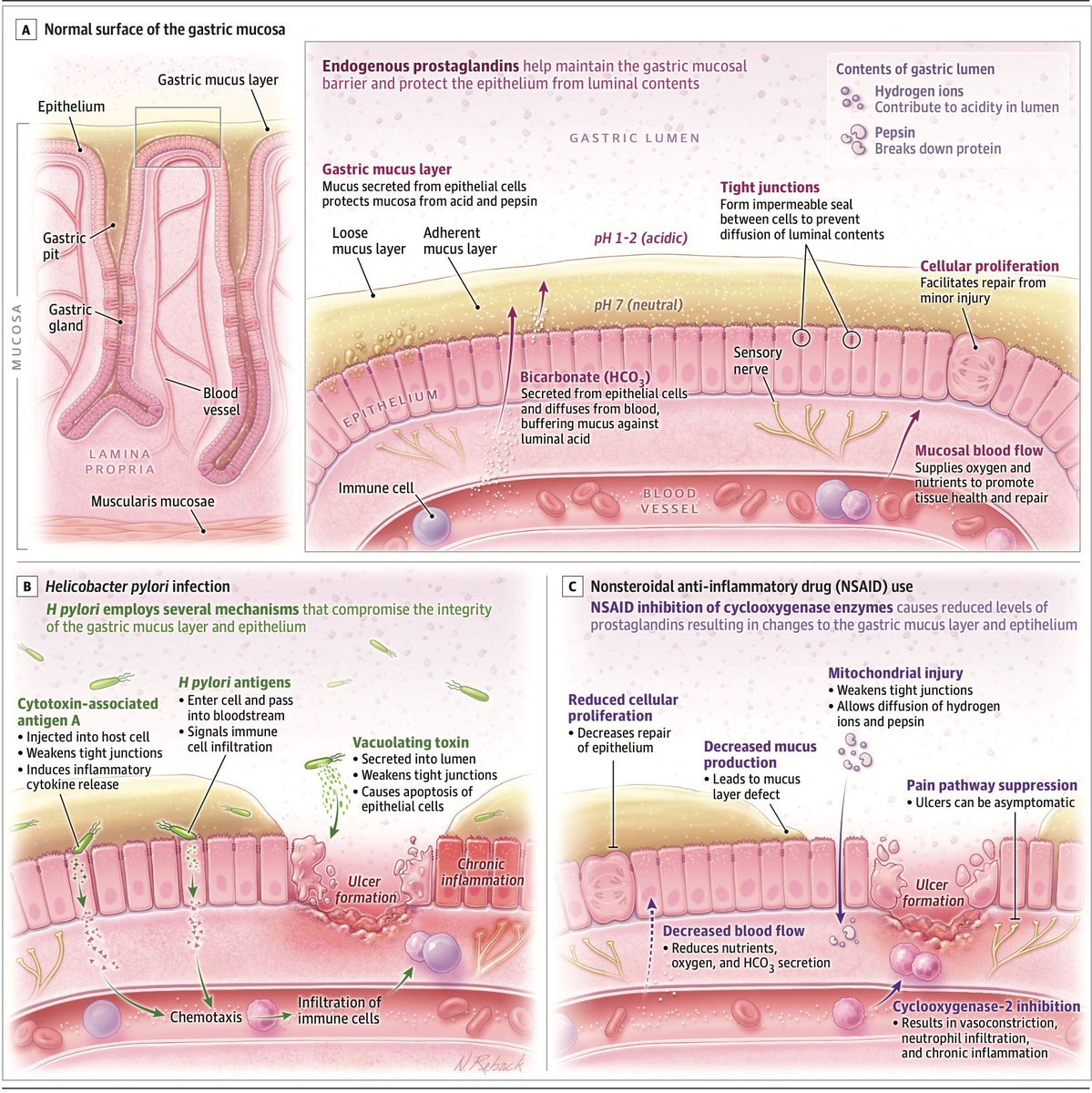 MedClubPage's tweet photo. #Gastroenterología #MedicinaInterna
La barrera de la mucosa gástrica y la patogénesis de la úlcera péptica.

JAMA. 2024. doi:10.1001/jama.2024.19094 https://t.co/C99SfU1wWu