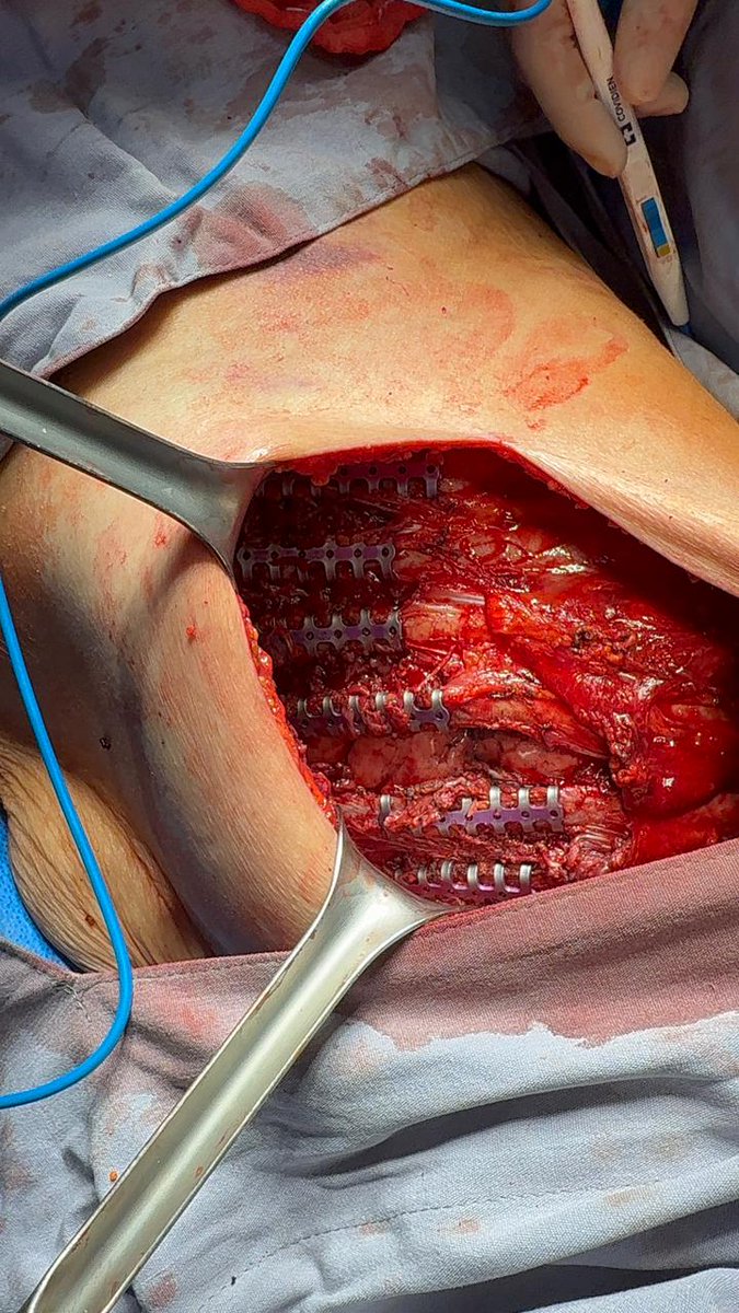 Tórax inestable derecho por atropellamiento. Fractura de todos los arcos costales.