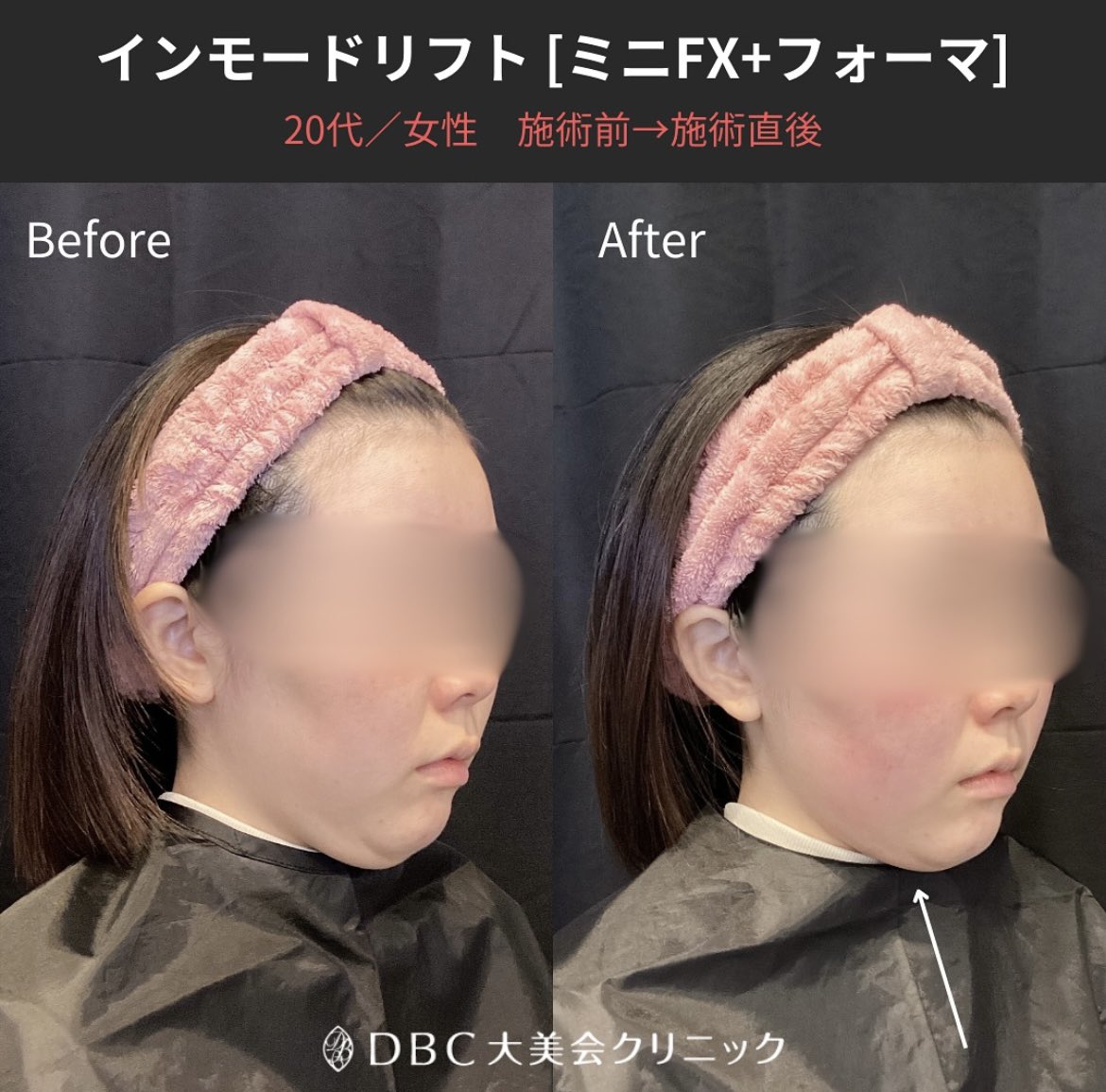 osakaumedabc's tweet photo. 急に寒くなりましたねっ風邪を引かないように暖かくして過ごしましょう😷

冬は代謝も落ちて皮下脂肪も付きやすいです。美味しいものも沢山あるし…顔のお肉どっかいけえええ>_<

今回のご案内は【インモード】🧏🏻‍♀️✨

#切らない小顔治療　#二重顎改善
#たるみケア　#リフトアップ　
#モニター価格 https://t.co/Rhyq3rSZ80