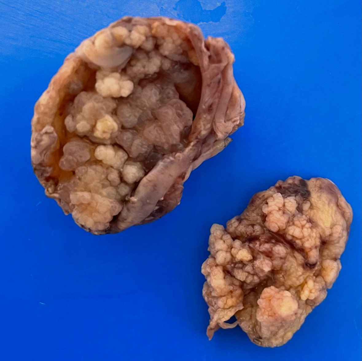 vintage81106614's tweet photo. The art of grossing. A 24 yo woman with abnormal uterine bleeding.  6x4cm left ovarian https://t.co/uU3YW3Kfmv Dx. Serous Ovarian Borderline Tumor.#pathology #pathologists #pathTweeter #GYNpath https://t.co/3GyYk4yPC3