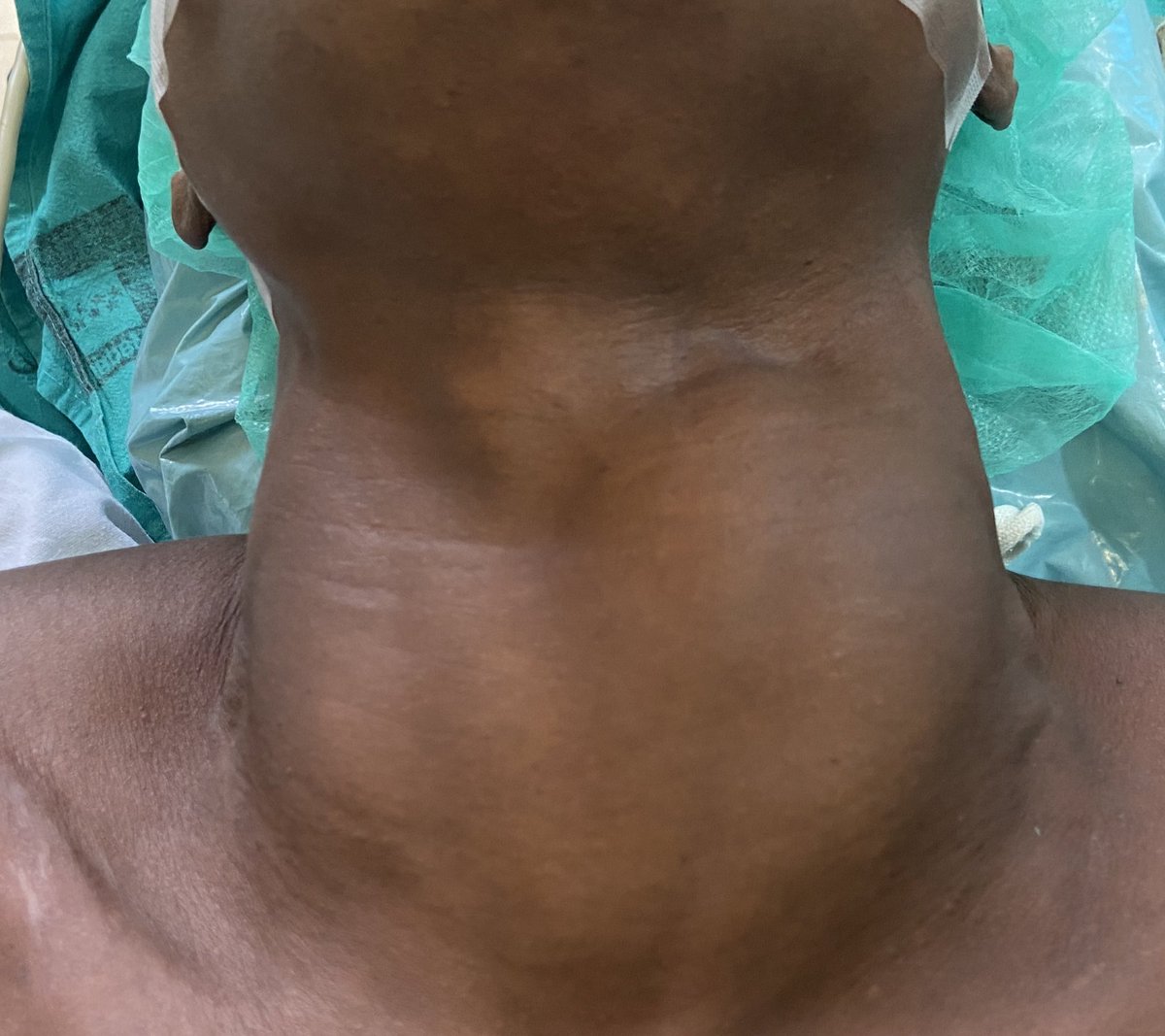 GuillenEnt's tweet photo. Cirugía de tiroides en 🇨🇲. El bocio endémico en zonas de África se debe sobre todo a la deficiencia de yodo en suministros de agua o a cantidades excesivas de flúor en la misma, pero también a alimentos o medicamentos bociógenos, infecciones y deficiencias vitamínicas. https://t.co/rwHDkv9t3M