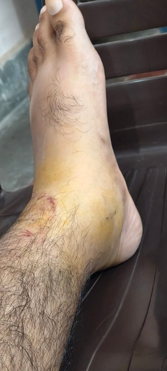 भाइयों एक एक्सीडेंट हो गया था इसलिए आपसे दो दिन बात नहीं हो पाई थी...कैसे है आप लोग?