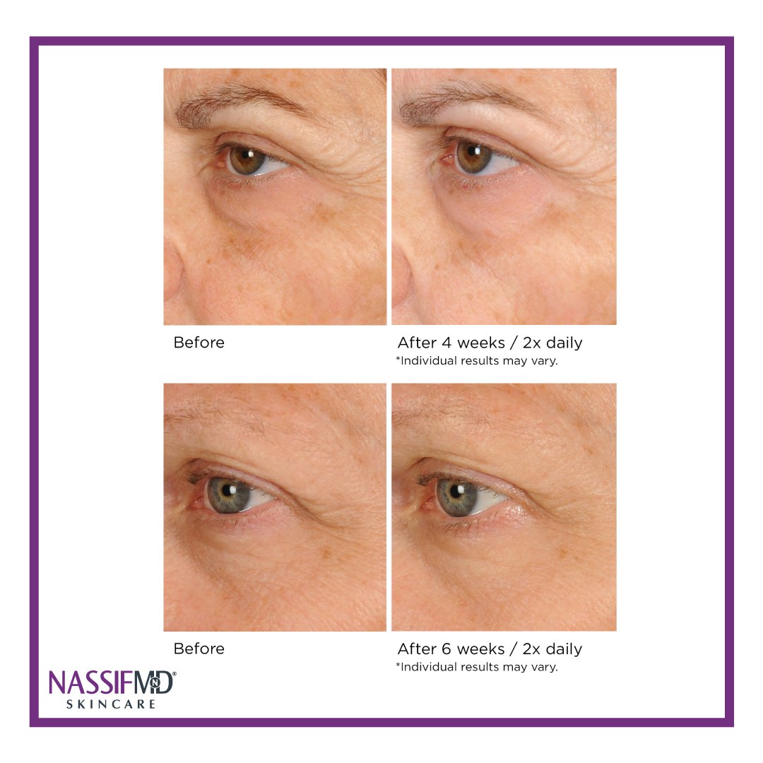 nassifmdsa's tweet photo. NassifMD Peri-Orbital Eye Complex - Patient Results (Combat the signs of ageing around the eyes) #nassifmds #skincarebydrnassif #skincare #antiaging https://t.co/KnaJSNYnlz