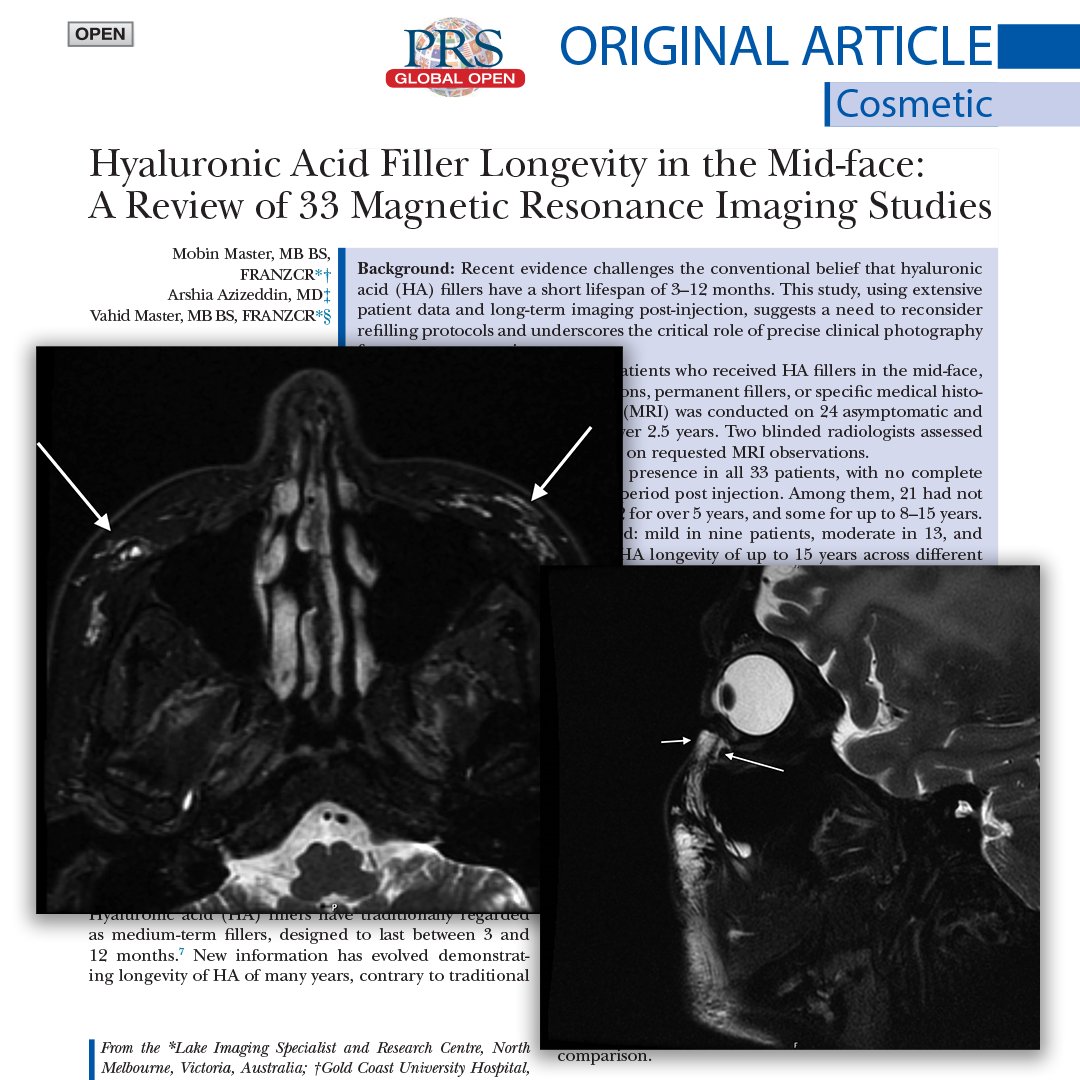 PRSGlobalOpen's tweet image. One of the most popular articles in #PRSGlobalOpen challenges the traditional belief that #hyaluronicAcidFillers last only 3–12 months. 🧠 How much longer? Read the article for FREE to find out!: bit.ly/HAfillerMRI