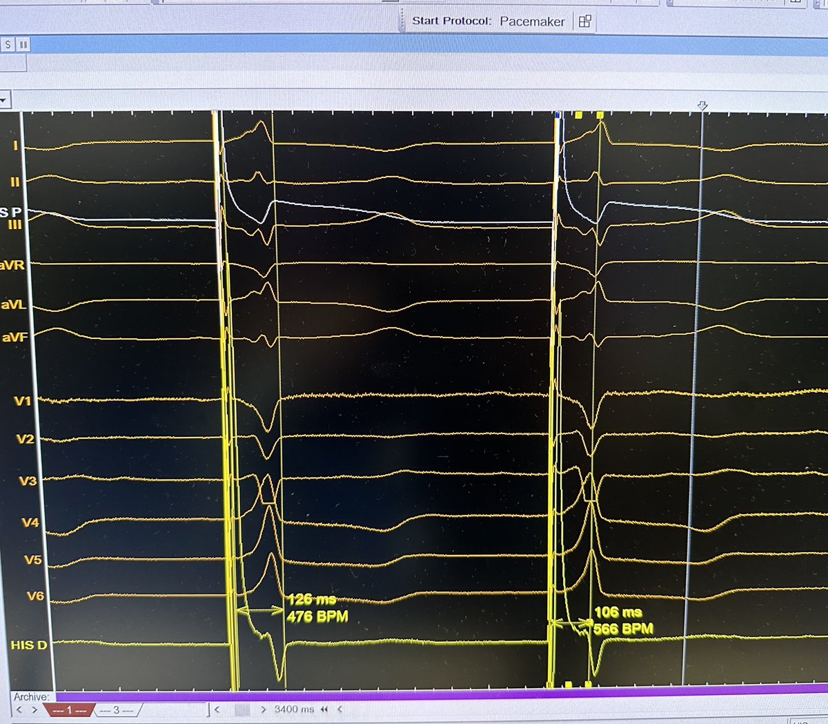 78 yo male with pacing induced CM (LVEF 28%). ECG and ventricular activation with UHF-ECG (RVOT pacing &amp; RBB-LAF block basally). Upgrade to HBP achieves restoration of V synchrony. Acute threshold 0.8 V@0.4 ms. We hope patient functional status to improve soon! <a href="/Dr_Pmorina/">Dr. Pablo Moriña Vázquez</a>