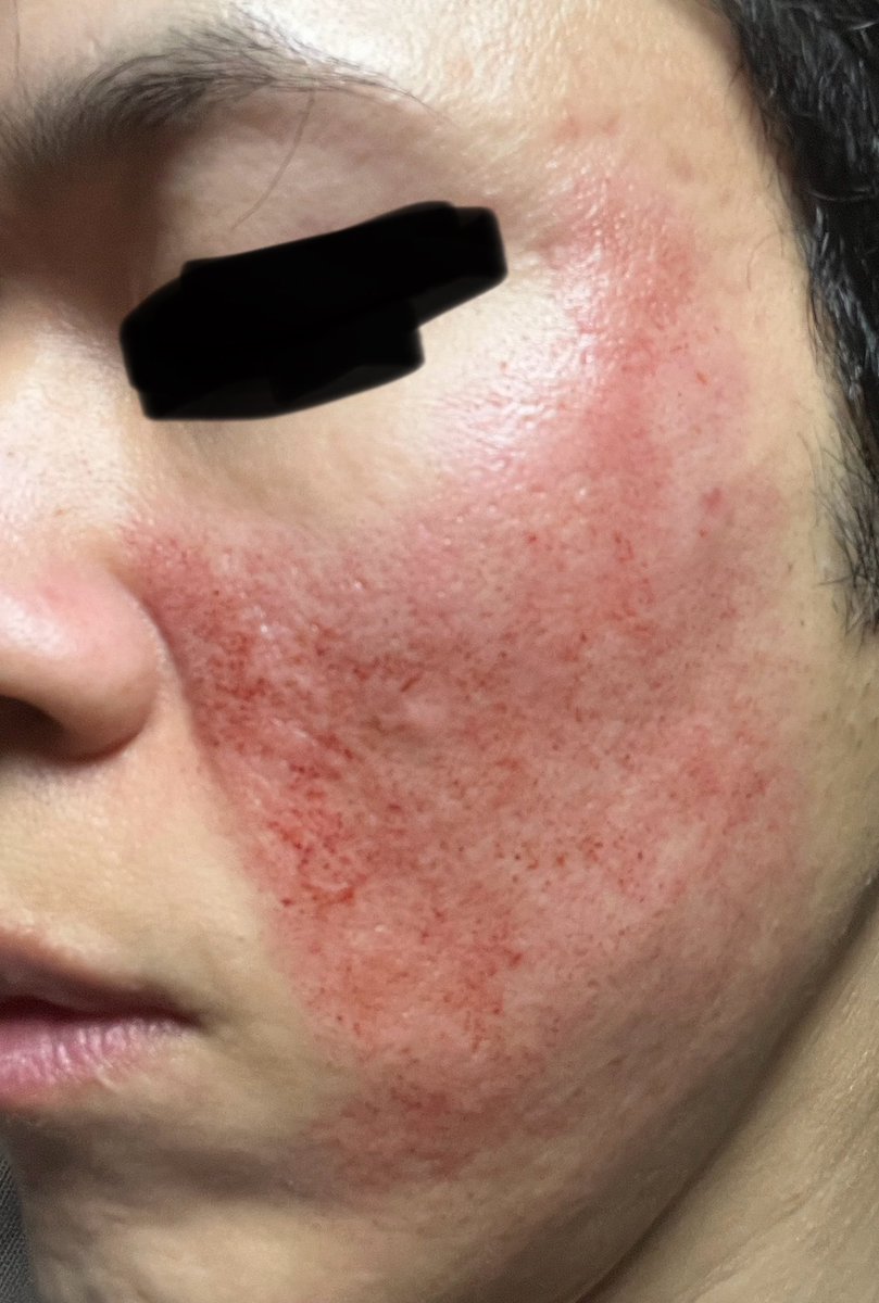 ピコハイ2時間後です
キュアジェットのつもりが今だけピコハイがあるとのことでピコハイでお願いしました。キュアジェットの10倍は痛かった💦
あとサブシジョンもしてもらいました！
自分じゃ何していいか分からないので肌見てすすめてくれるのはありがたいです😊