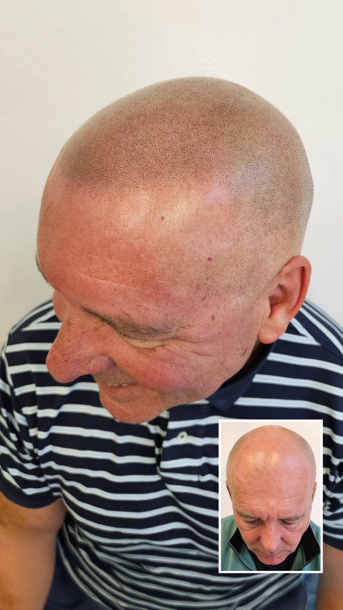 SkalpWorldwide's tweet image. The difference a hairline can make 👌

Photo taken straight after 3rd session.

#skalp #scalpmicropigmentation #SMP #hairtattoo #scalptattoo #hairlinetattoo #hairrestoration #hairlosssolution #baldnesssolution #hairtransplant #alopecia #smpresults