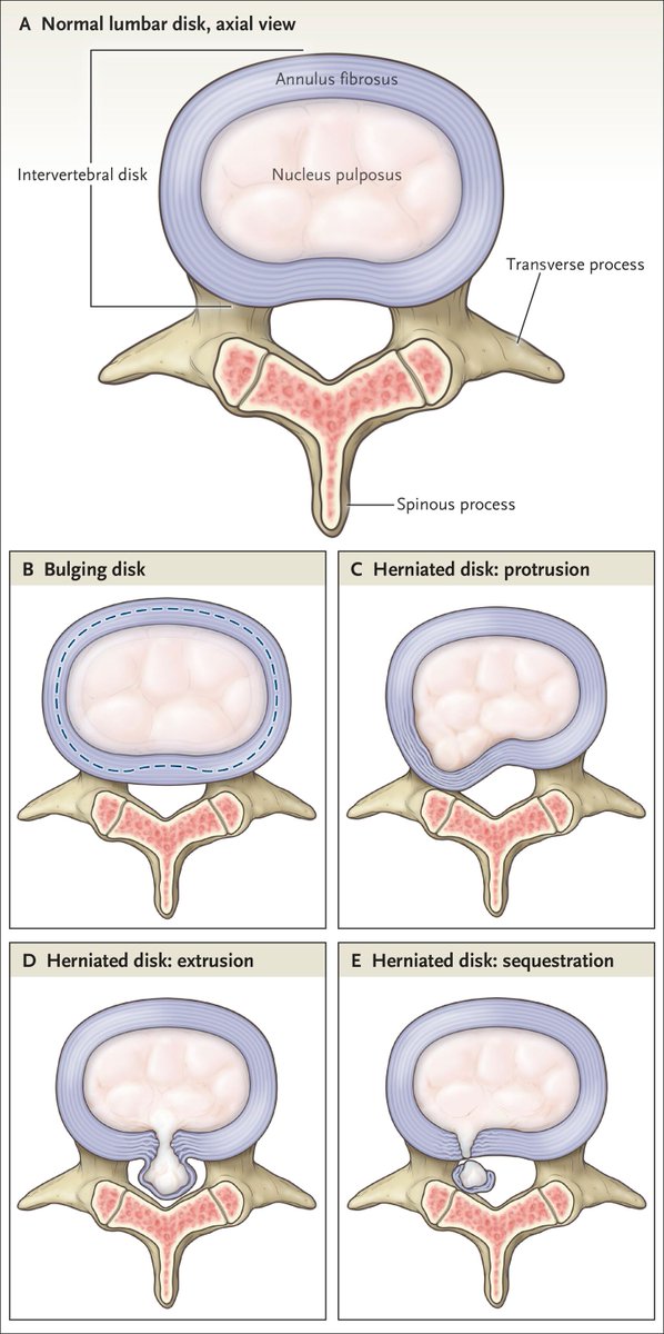Physio Meets Science (@physiomescience) on Twitter photo Just published in European Spine Journal 🔥
Incidence of and risk factors for lumbar disc herniation with radiculopathy in adults: a systematic review
pubmed.ncbi.nlm.nih.gov/39453541/
Illustration: pubmed.ncbi.nlm.nih.gov/27144851/ Just published in European Spine Journal 🔥
Incidence of and risk factors for lumbar disc herniation with radiculopathy in adults: a systematic review
pubmed.ncbi.nlm.nih.gov/39453541/
Illustration: pubmed.ncbi.nlm.nih.gov/27144851/