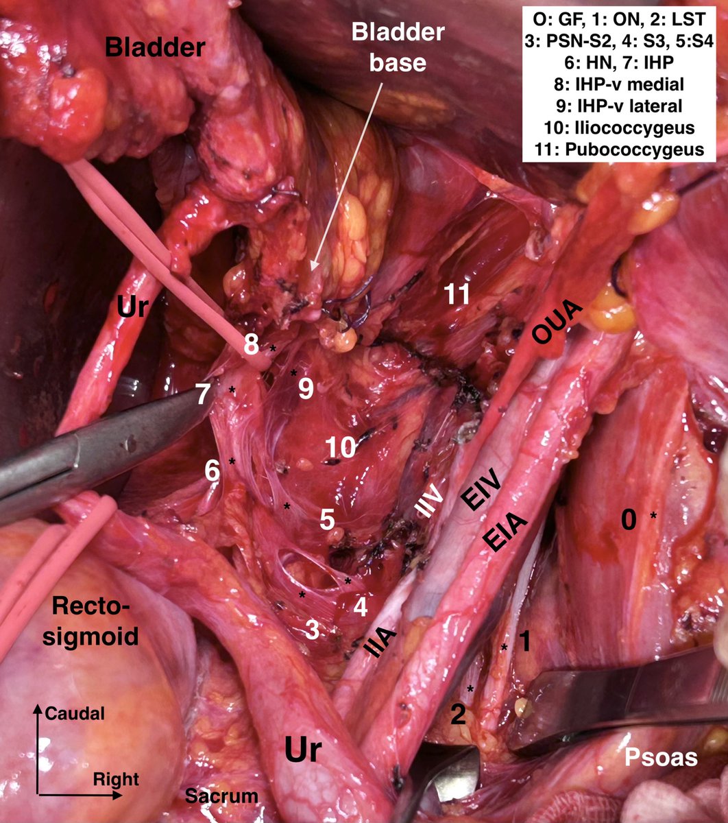 Ilker Selcuk MD PhD (@ilkerselcukmd) on Twitter photo Type C2N RH, Selective Systematic Nerve-Sparing Radical Hysterectomy , check the unedited full video at Youtube youtu.be/q_Dg6hmac68?si…
<a href="/IJGConline/">IJGC</a> <a href="/pedroramirezMD/">Pedro T Ramirez</a> <a href="/ESGO_society/">ESGO</a> <a href="/ENYGO_official/">European Network of Young Gynae Oncologists</a> <a href="/gynoncjnls/">@GynOncJnls</a> <a href="/jgo_journal/">Journal of Gynecologic Oncology</a> <a href="/DrJonnys/">Dr. Johnny Stewart. MD , FRCSC / RMC, CAF</a> <a href="/GynMe4/">SoMe4GynOnc</a> Type C2N RH, Selective Systematic Nerve-Sparing Radical Hysterectomy , check the unedited full video at Youtube youtu.be/q_Dg6hmac68?si…
<a href="/IJGConline/">IJGC</a> <a href="/pedroramirezMD/">Pedro T Ramirez</a> <a href="/ESGO_society/">ESGO</a> <a href="/ENYGO_official/">European Network of Young Gynae Oncologists</a> <a href="/gynoncjnls/">@GynOncJnls</a> <a href="/jgo_journal/">Journal of Gynecologic Oncology</a> <a href="/DrJonnys/">Dr. Johnny Stewart. MD , FRCSC / RMC, CAF</a> <a href="/GynMe4/">SoMe4GynOnc</a>