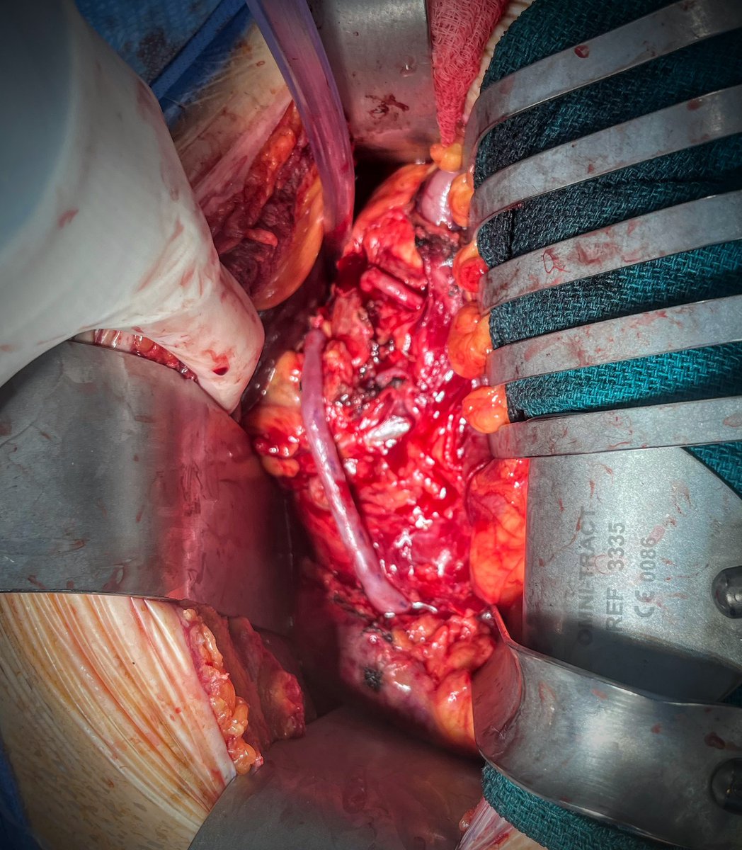 JHH Vascular Surgery (@jhhvascular) on Twitter photo Who says open volume for vascular is decreasing? Not here <a href="/JHHVascular/">JHH Vascular Surgery</a>!
Hepatorenal bypass for renovascular HTN followed by #Sundayfunday hepatorenal bypass to maintain renal perfusion prior to explant of failing EVAR with bilateral renal snorkels <a href="/JamesHBlackMD/">James H Black, MD</a> <a href="/AlexisLauria1/">Alexis Lauria</a> Who says open volume for vascular is decreasing? Not here <a href="/JHHVascular/">JHH Vascular Surgery</a>!
Hepatorenal bypass for renovascular HTN followed by #Sundayfunday hepatorenal bypass to maintain renal perfusion prior to explant of failing EVAR with bilateral renal snorkels <a href="/JamesHBlackMD/">James H Black, MD</a> <a href="/AlexisLauria1/">Alexis Lauria</a>