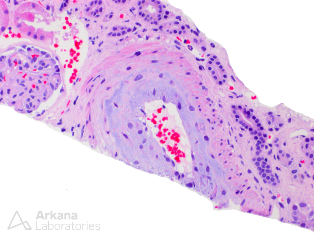 arkanalabs's tweet image. What is this finding and what is the likely etiology?

#DiagnoseThis #renalpath #nephropath