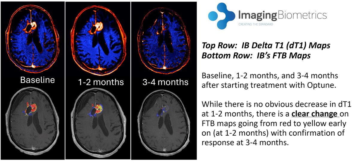ImgBiometrics's tweet image. An initial study conducted in the Schmainda Lab @MedicalCollege has demonstrated the ability of IB’s FTB maps to be an early predictor of response to Optune treatment for brain tumor patients. A larger study is underway.
#Optune #GBM #braintumors #SNO #ASNR #ASFNR