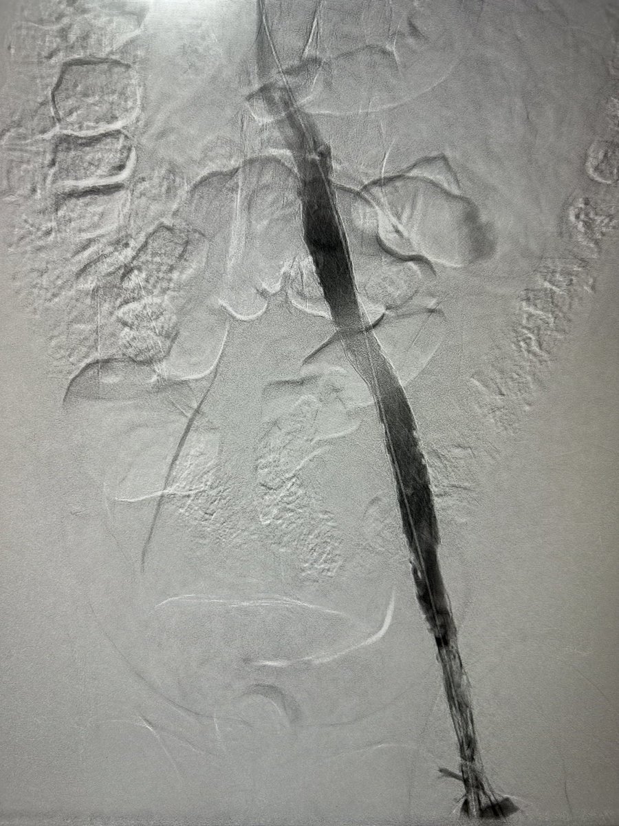 Pelvic venous thrombosis with leg ulcers