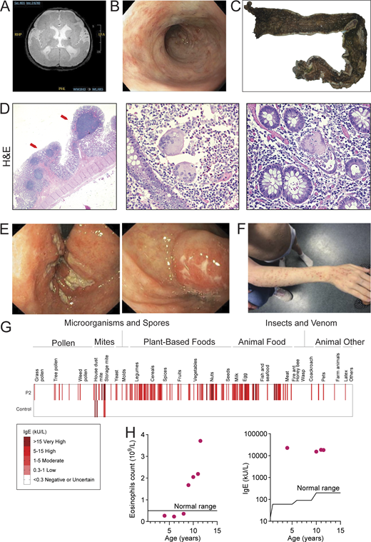 Waggoner Lab (@labwaggoner) on Twitter photo ITGAV variants cause a previously unknown human disease characterized by brain and developmental defects in the case of complete loss-of-function and atopy, neurodevelopmental defects, and colitis in cases of incomplete loss-of-function <a href="/JExpMed/">Journal of Experimental Medicine</a>
doi.org/10.1084/jem.20… ITGAV variants cause a previously unknown human disease characterized by brain and developmental defects in the case of complete loss-of-function and atopy, neurodevelopmental defects, and colitis in cases of incomplete loss-of-function <a href="/JExpMed/">Journal of Experimental Medicine</a>
doi.org/10.1084/jem.20…