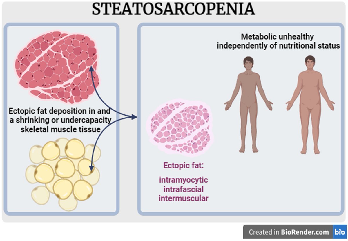 🧵 Thread on Steatosarcopenia: A New Classification Bridging Sarcopenia &amp; Myosteatosis

1/ 📢 What is Steatosarcopenia?
A new term proposed to describe the simultaneous presence of sarcopenia (muscle loss) and myosteatosis (fat infiltration within muscle), independent of obesity.