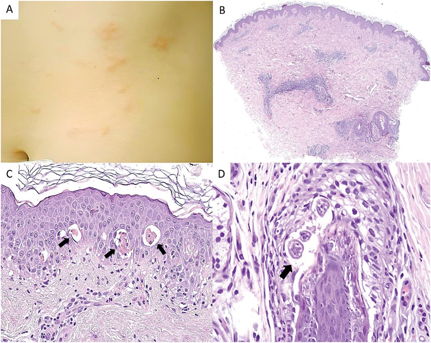 AJDP_Journal's tweet photo. #WhatsNewInDermpath
Hookworm Folliculitis: Report of two cases of Cutaneous Larva Migrans with histologically identified follicular involvement
H&E: nematode larvae traversing the hair follicle. The hookworm larvae are observed creating tunnels within the external root sheath. https://t.co/XEvS6fFQVs