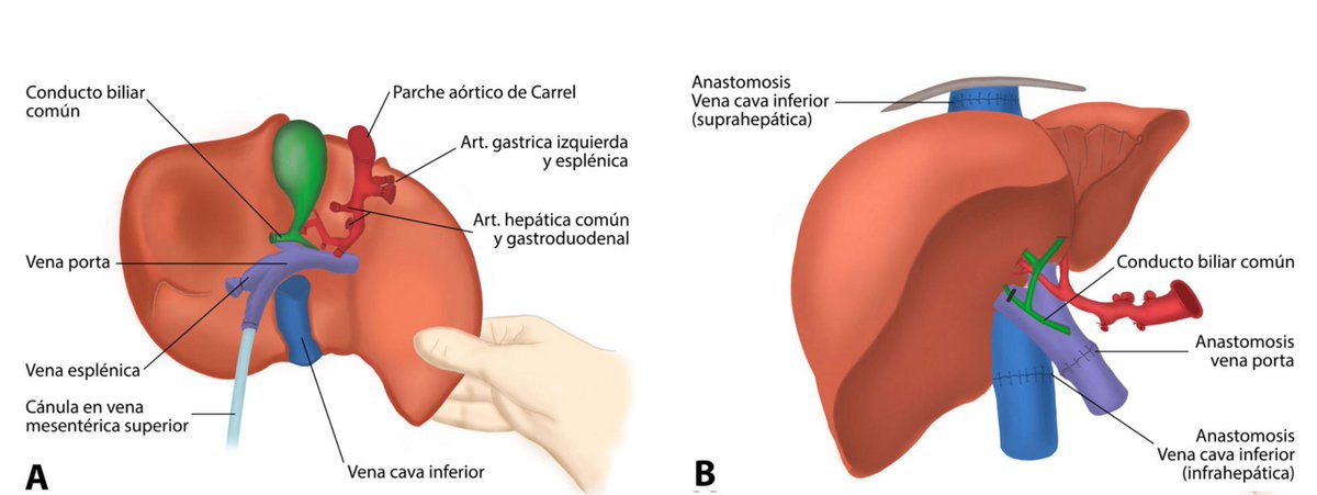 LuisAntonioDiaz's tweet photo. Junto al team trasplante @FacMedicinaUC @ucatolica queremos compartir este review de trasplante hepático recientemente publicado en @revmedchile ! @juanpabloarab @MarcoArreseMD @jivargasd @AlejandroSoza @carlos_bntz @dibmartin @FcoIdalsoaga @alehlatam

👉https://t.co/90uGOnXhzS https://t.co/0MuiFMXVMQ
