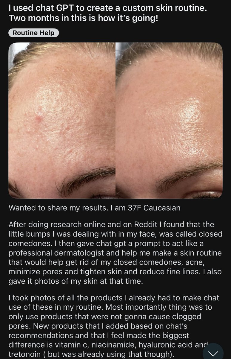 Chatgpt kullanımına çok güzel bir örnek.

37 yaşında bir kadın her gün cildinin fotoğraflarını çekip ChatGPT’ye yüklemiş ve bir dermatolog gibi kendisine kapalı komedonlarımı giderecek, sivilceleri azaltacak, gözenekleri küçültecek, cildi sıkılaştıracak ve ince çizgileri