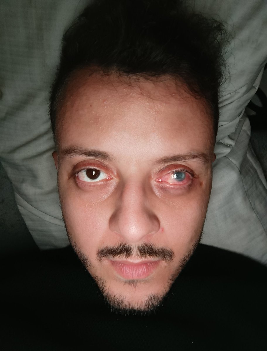 ahmedshameya995's tweet image. I Swear I Want To Cry From The Pain In My Eye.
Again Please Pray For My Eye.
gofund.me/e72769fc