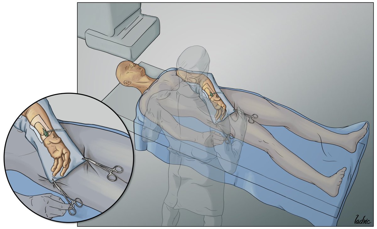 Comparison of Left Radial vs Femoral Artery Access for Coronary Angiography &amp; PCI After CABG

LRA group =  8,787 pts (34.6%), 
and the FA group = 16,578 pts

LRA access was associated w⬇️risks of the composite outcome of 30-day death ,bleeding &amp; stroke 

jacc.org/doi/full/10.10…