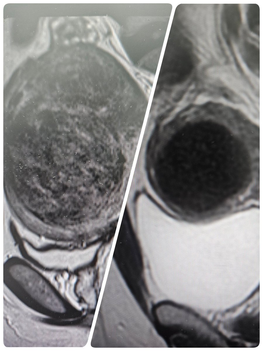 مريضتان تم عمل قسطره للأورام الليفيه 
وعلامة الاستجابه في فحص الرنين المغناطيسي 
إختفاء الورم أو الموت الكامل للأورم 
طبعا مع إختفاء الأعراض المصاحبه 
<a href="/Dawaliclinic1/">مركز عيادات دوالي 🥼</a> 
<a href="/pairsmedia/">PAIRS</a>