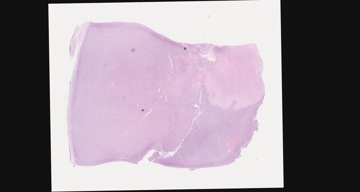 MirunaPopescu13's tweet photo. 28 y/o M w/ 12 cm retroperitoneal mass attached to and infiltrating bowel wall.

What are your thoughts? 🔬

Credits🙏🏼: https://t.co/wQ8vnqUsZJ (check out free WSI here &amp; many others! Great learning resource)! https://t.co/134FO0vqCj