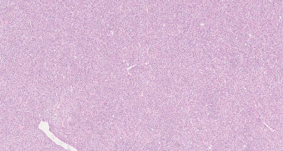 MirunaPopescu13's tweet photo. 28 y/o M w/ 12 cm retroperitoneal mass attached to and infiltrating bowel wall.

What are your thoughts? 🔬

Credits🙏🏼: https://t.co/wQ8vnqUsZJ (check out free WSI here &amp; many others! Great learning resource)! https://t.co/134FO0vqCj