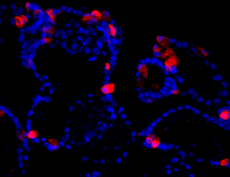 New research suggests that LRRK2 hyperactivity in intestinal macrophages causes Paneth cell defects in preclinical models and patients with Crohn’s disease. 

Learn more in <a href="/SciImmunology/">Science Immunology</a>: bit.ly/3Z1HbBs