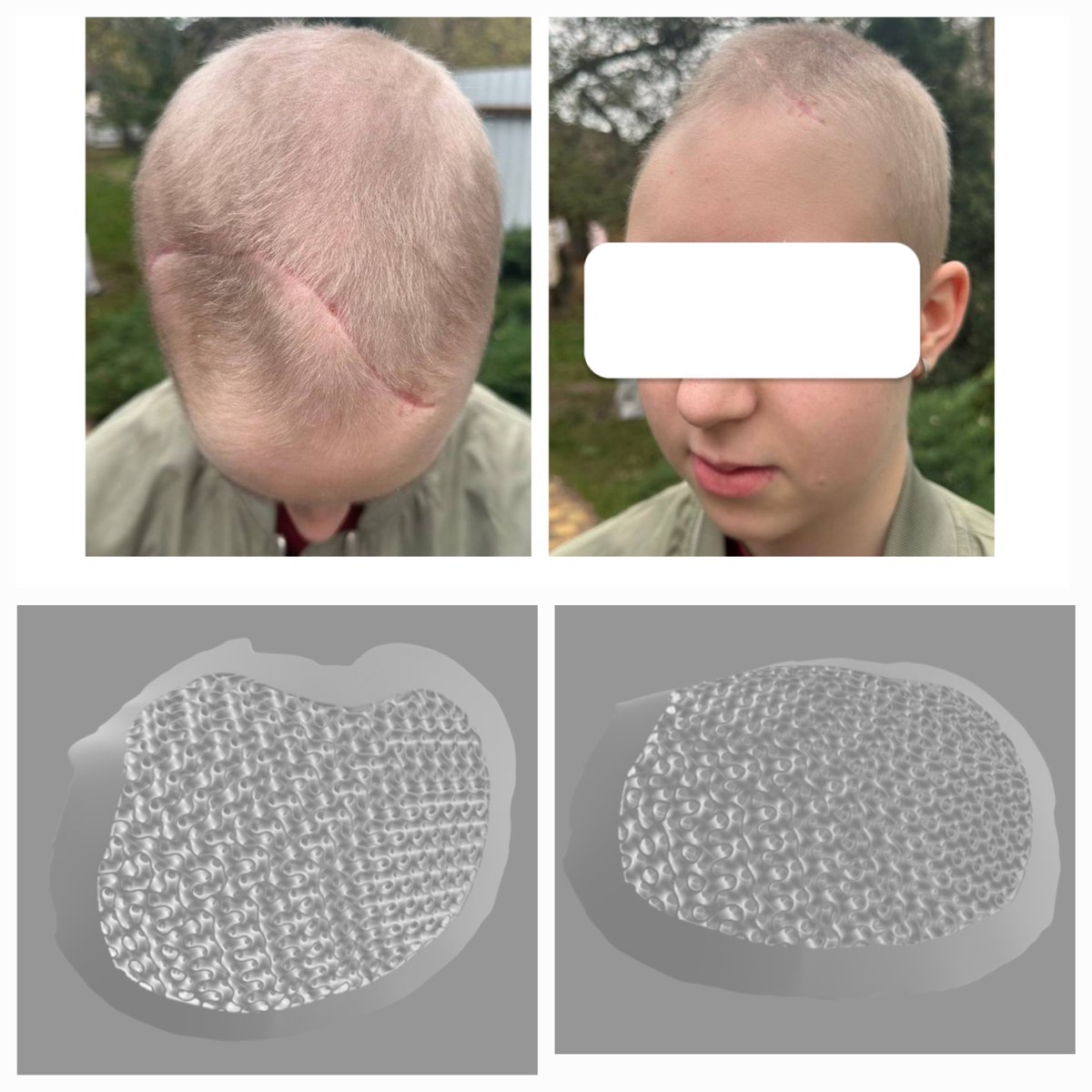 mar_watrobinski's tweet photo. Szanowni
#Stefcia
Jeszcze nie ma nawet połowy kwoty.
Mamy już projekt implantu gotowy do druku, ale bez wsparcia zabieg się nie odbędzie.
Mózg tego dziecka można dotknąć przez skórę głowy i opony mózgowe. Nic go nie chroni.
Proszę o pomoc i RT.
https://t.co/D7HEcQ7yvN https://t.co/9m0Tario2a